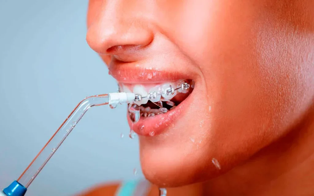 Уход за брекетами после установки