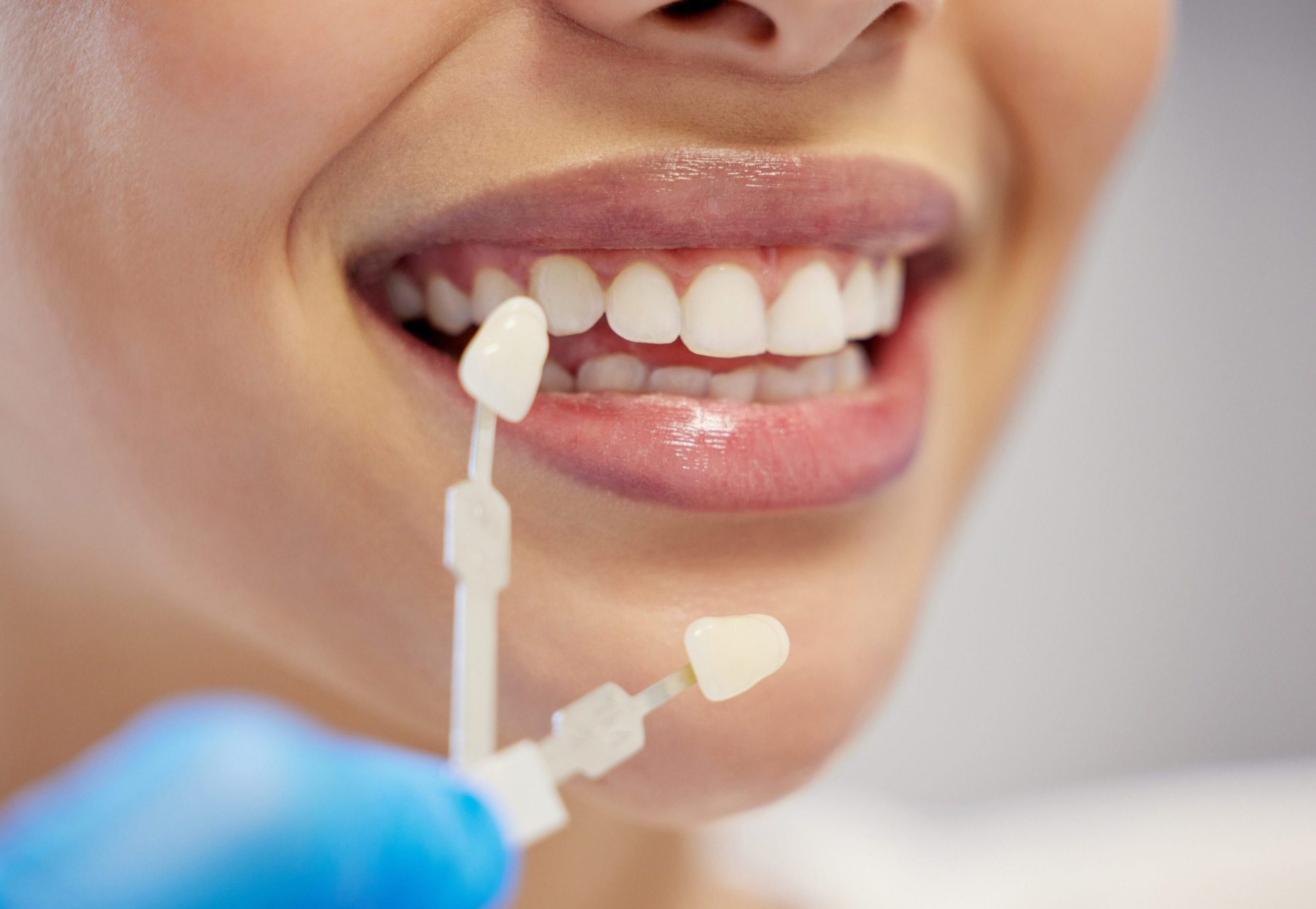 keramicheskie-viniry-astana-2