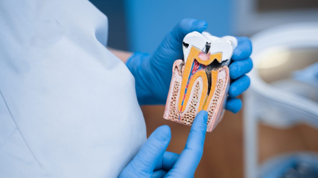 Dummy of a sick tooth with caries, Dentist shows structure of the teeth.