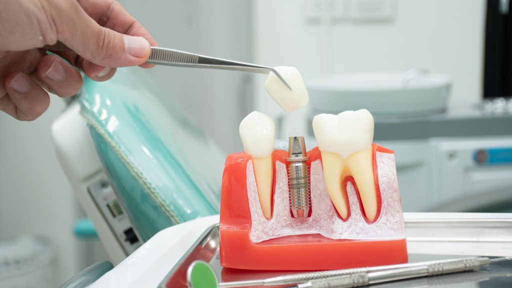 Examples of dental implants in the jawbone of the patient.