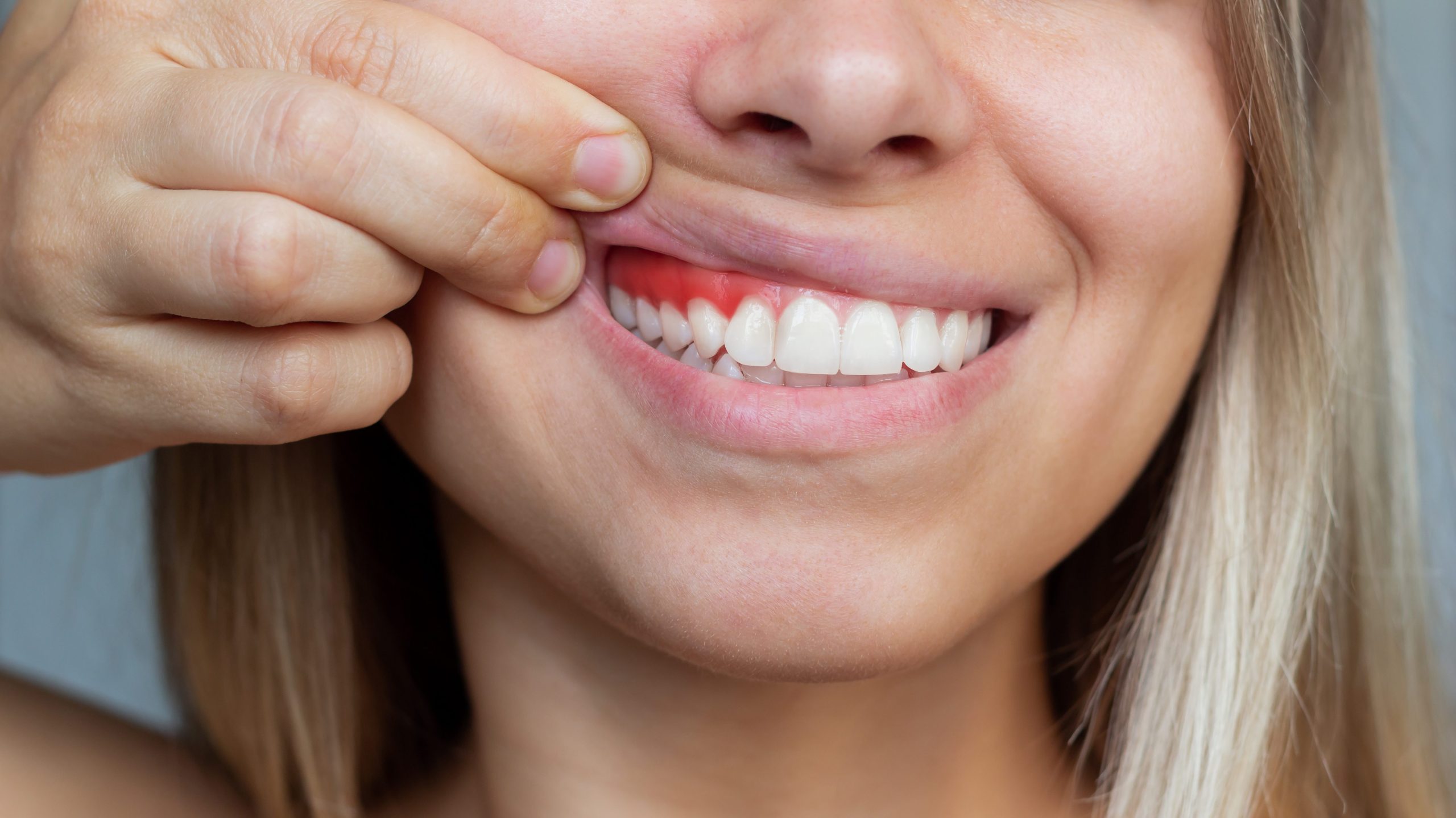 gum-inflammation-closeup-young-woman-showing-bleeding-gums-gray-background-dentistry