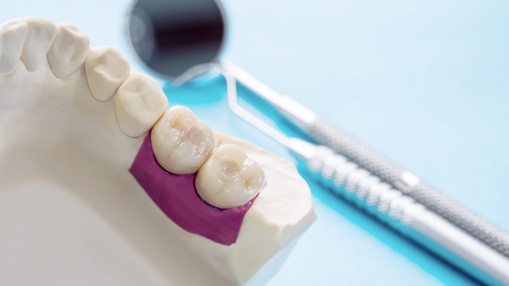 Implant Prosthodontics or Prosthetic