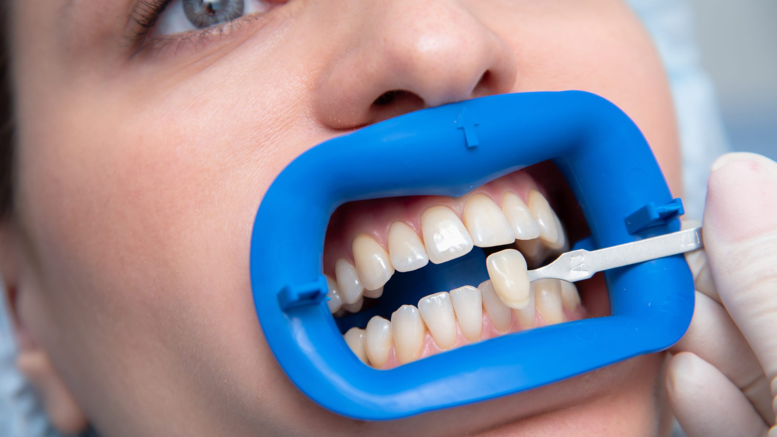 procedure for comparing the color shades of teeth using tests before bleaching