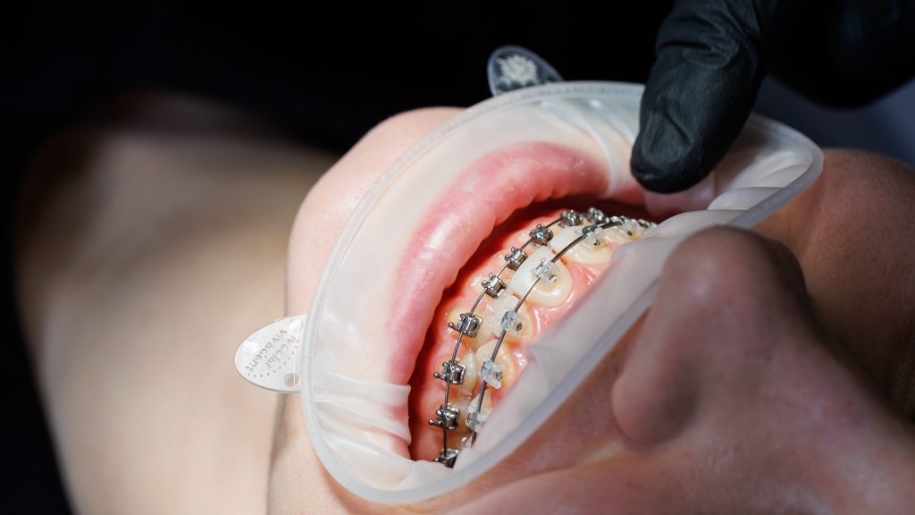 Close-up of teeth with metal braces. Orthodontic treatment of the jaw