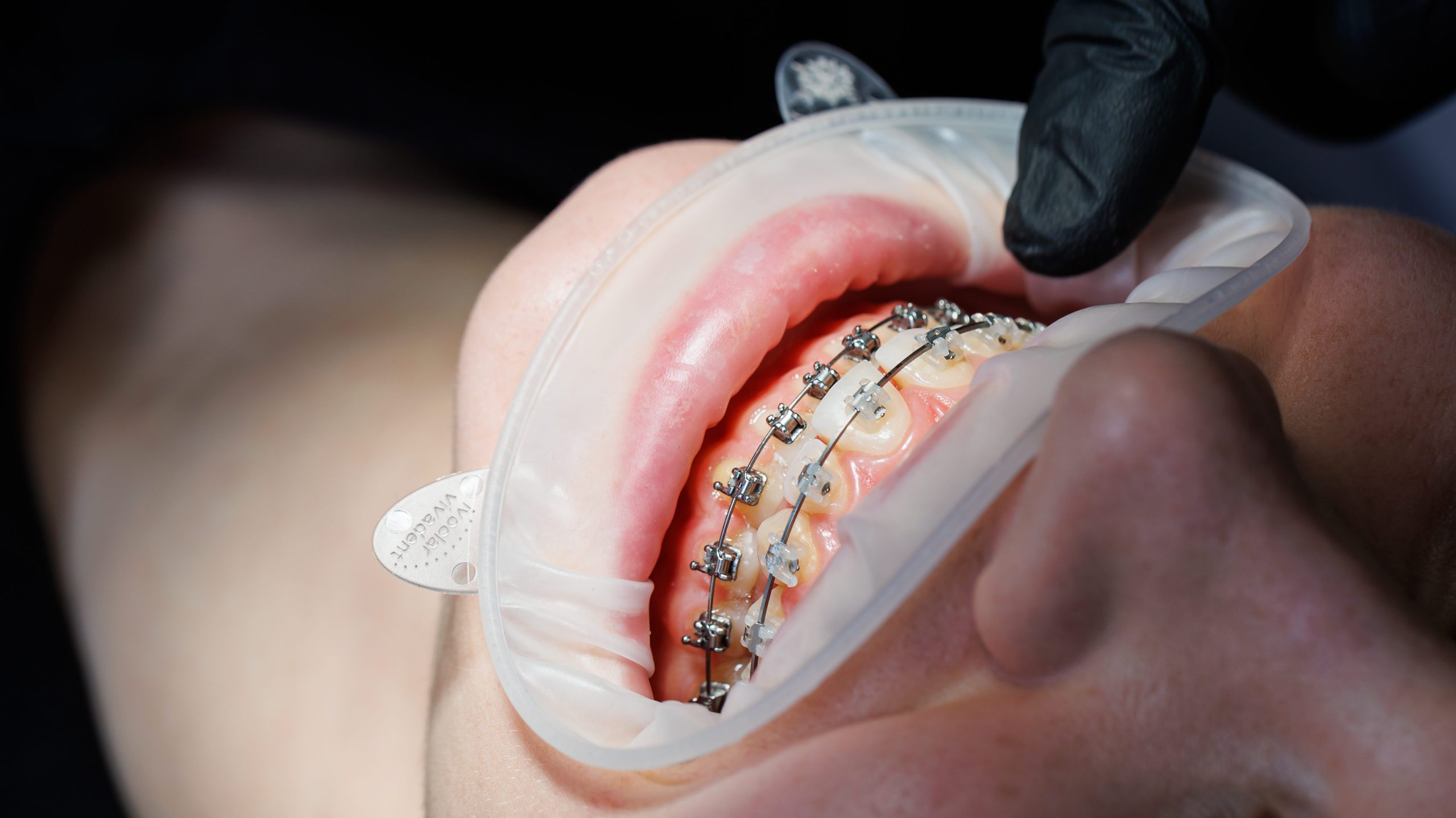 Close-up of teeth with metal braces. Orthodontic treatment of the jaw