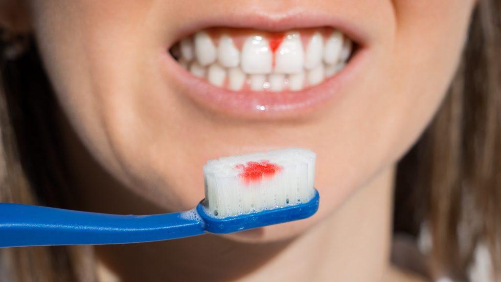 Woman mouth with bleeding gums during teeth brushing. Avitaminosis, gingivitis